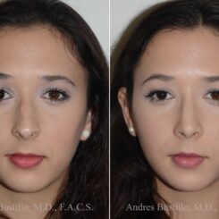 Rhinoplasty Before and After Photos in Miami, FL, Patient 17846