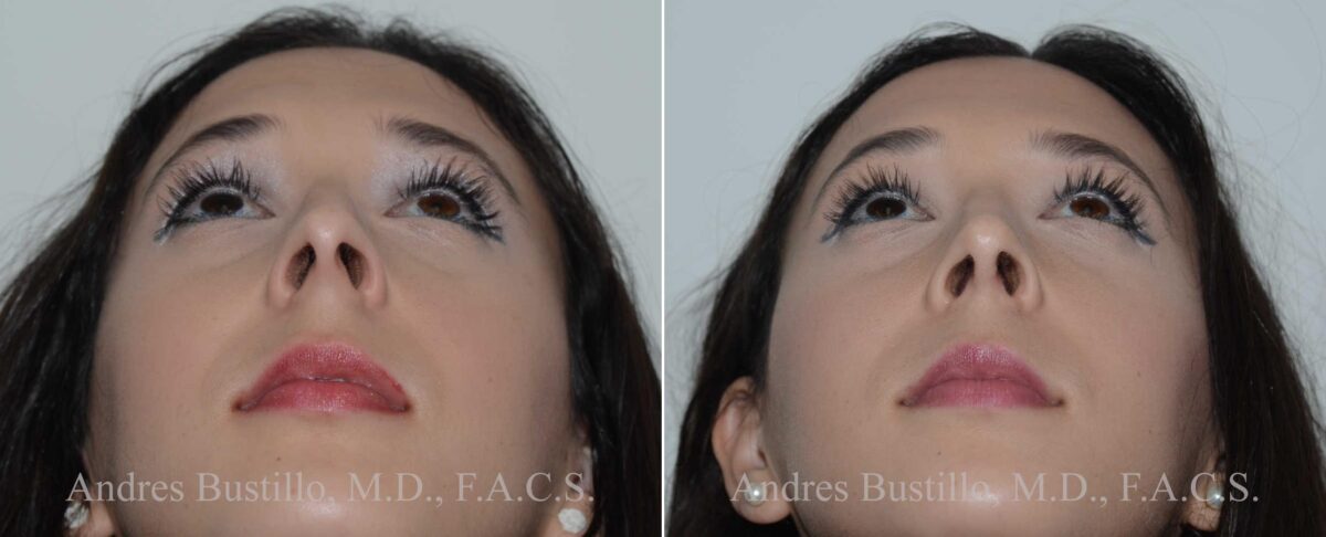 Rhinoplasty Before and After Photos in Miami, FL, Patient 17846