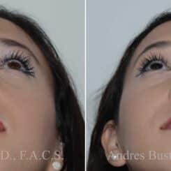 Rhinoplasty Before and After Photos in Miami, FL, Patient 17846
