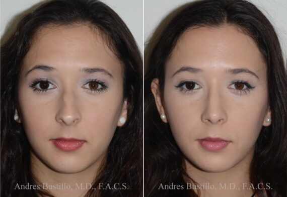 Rhinoplasty Before and After Photos in Miami, FL, Patient 17846