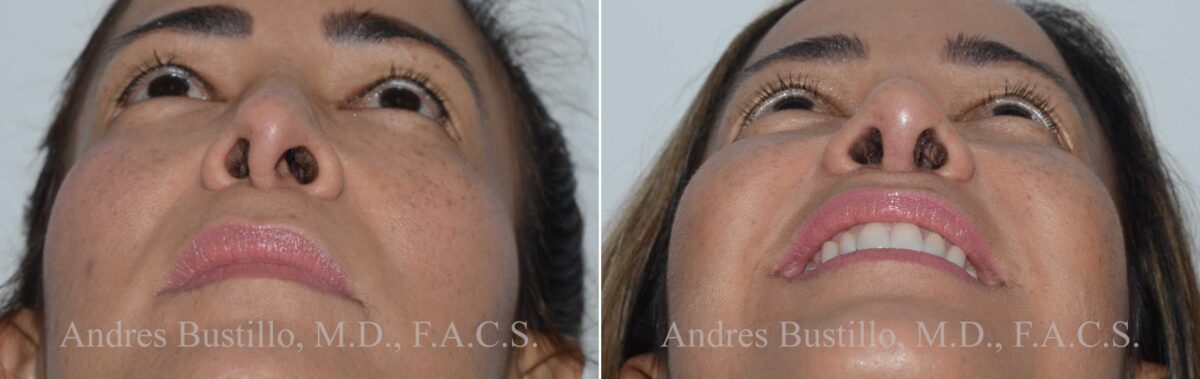 Revision Rhinoplasty Before and After Photos in Miami, FL, Patient 17864