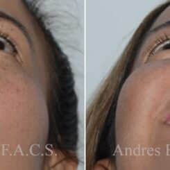 Revision Rhinoplasty Before and After Photos in Miami, FL, Patient 17864