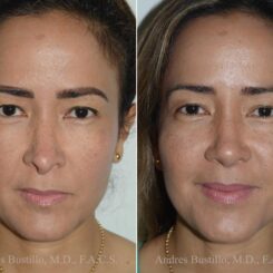 Revision Rhinoplasty Before and After Photos in Miami, FL, Patient 17864