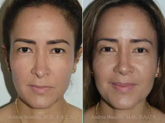 Revision Rhinoplasty Before and After Photos in Miami, FL, Patient 17864