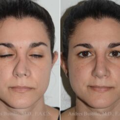 Revision Rhinoplasty Before and After Photos in Miami, FL, Patient 17873