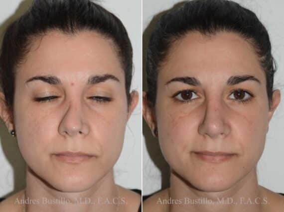 Revision Rhinoplasty Before and After Photos in Miami, FL, Patient 17873