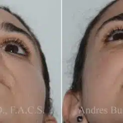 Revision Rhinoplasty Before and After Photos in Miami, FL, Patient 17873