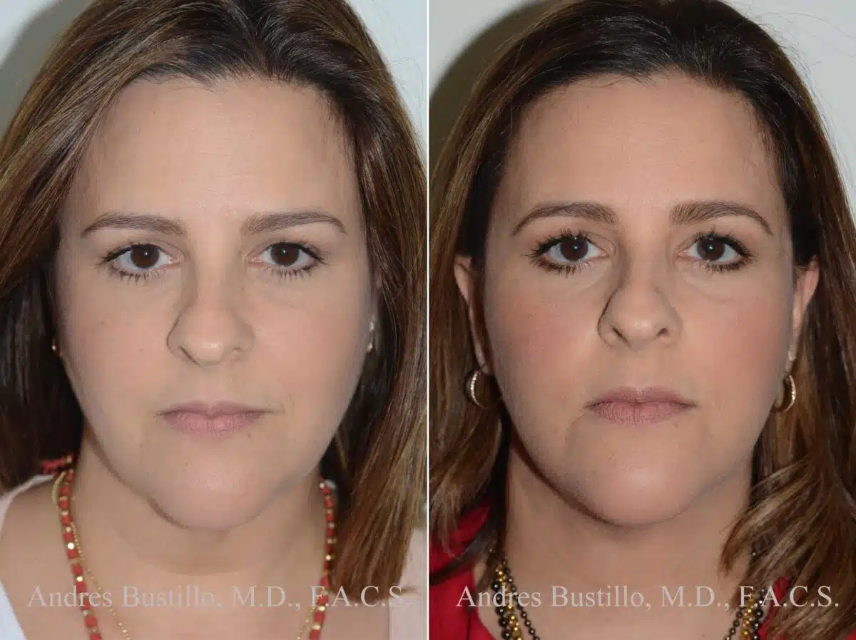 Deep Plane Facelift Before and After Photos in Miami, FL, Patient 17891