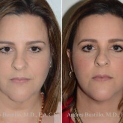 Deep Plane Facelift Before and After Photos in Miami, FL, Patient 17891