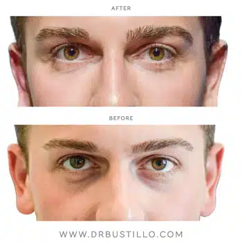 Eyelid Filler in Miami, FL