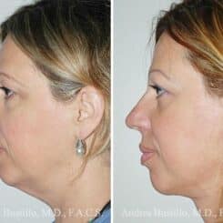 Deep Plane Facelift Before and After Photos in Miami, FL, Patient 15713