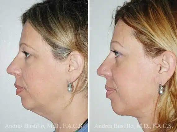 Deep Plane Facelift Before and After Photos in Miami, FL, Patient 15713