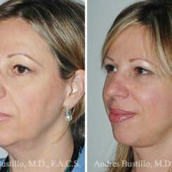 Deep Plane Facelift Before and After Photos in Miami, FL, Patient 15713