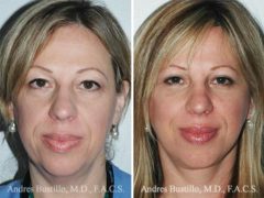 Deep Plane Facelift Before and After Photos in Miami, FL, Patient 15713