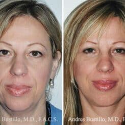 Deep Plane Facelift Before and After Photos in Miami, FL, Patient 15713