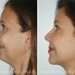 Deep Plane Facelift Before and After Photos in Miami, FL, Patient 15741