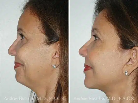 Deep Plane Facelift Before and After Photos in Miami, FL, Patient 15741