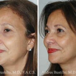 Deep Plane Facelift Before and After Photos in Miami, FL, Patient 15741