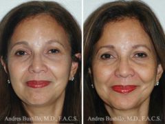 Deep Plane Facelift Before and After Photos in Miami, FL, Patient 15741