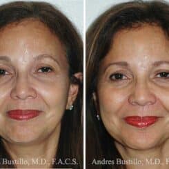 Deep Plane Facelift Before and After Photos in Miami, FL, Patient 15741