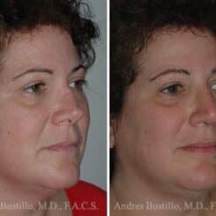 Revision Rhinoplasty Before and After Photos in Miami, FL, Patient 15665