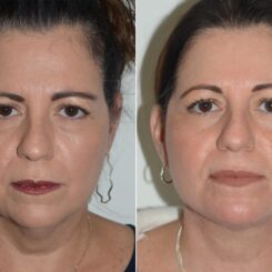 Deep Plane Facelift Before and After Photos in Miami, FL, Patient 19103