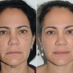 Deep Plane Facelift Before and After Photos in Miami, FL, Patient 19114