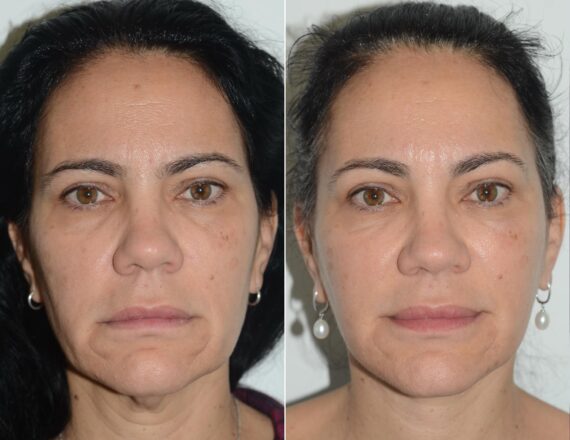 Deep Plane Facelift Before and After Photos in Miami, FL, Patient 19114