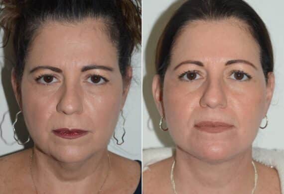 Deep Plane Facelift Before and After Photos in Miami, FL, Patient 19103