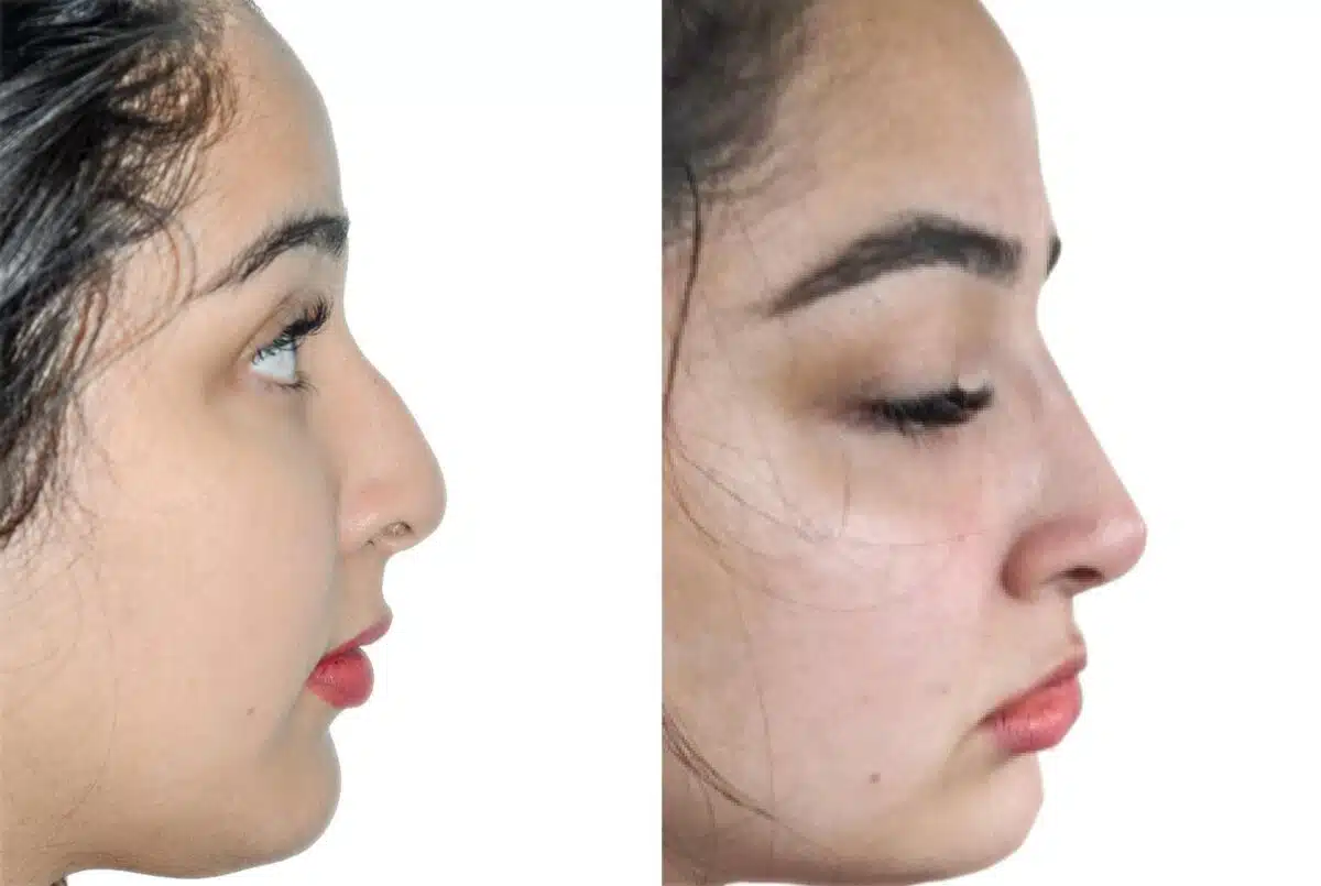 Liquid Rhinoplasty Before and After Photos in Miami, FL, Patient 19129