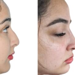 Liquid Rhinoplasty Before and After Photos in Miami, FL, Patient 19129