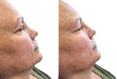 Liquid Rhinoplasty Before and After Photos in Miami, FL, Patient 19133