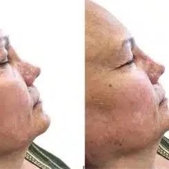 Liquid Rhinoplasty Before and After Photos in Miami, FL, Patient 19133