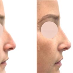 Liquid Rhinoplasty Before and After Photos in Miami, FL, Patient 19124
