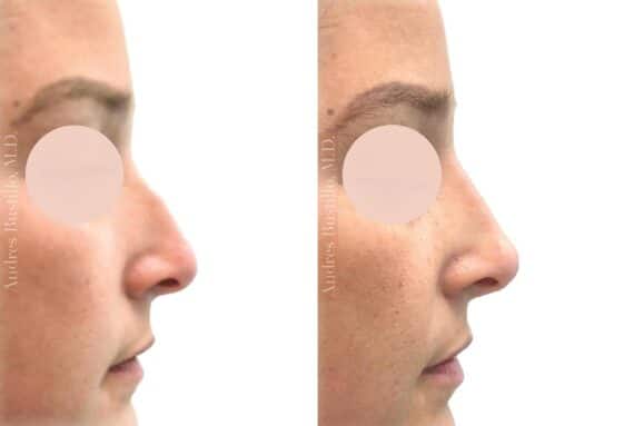 Liquid Rhinoplasty Before and After Photos in Miami, FL, Patient 19124