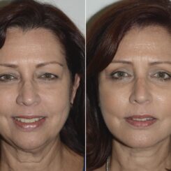 Deep Plane Facelift Before and After Photos in Miami, FL, Patient 19158