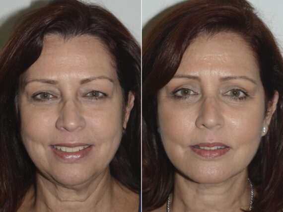 Deep Plane Facelift Before and After Photos in Miami, FL, Patient 19158