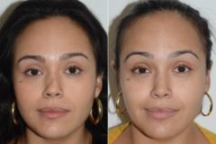 Revision Rhinoplasty Before and After Photos in Miami, FL, Patient 19201