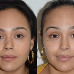 Revision Rhinoplasty Before and After Photos in Miami, FL, Patient 19201