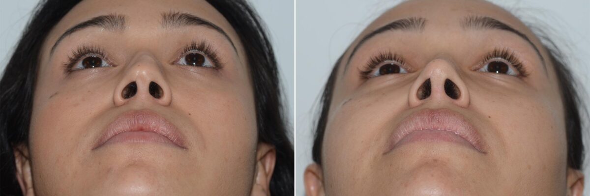 Revision Rhinoplasty Before and After Photos in Miami, FL, Patient 19201