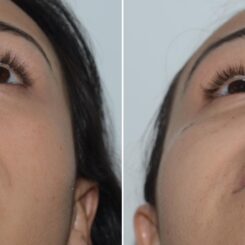 Revision Rhinoplasty Before and After Photos in Miami, FL, Patient 19201
