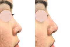 Liquid Rhinoplasty Before and After Photos in Miami, FL, Patient 19222