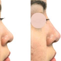 Liquid Rhinoplasty Before and After Photos in Miami, FL, Patient 19222