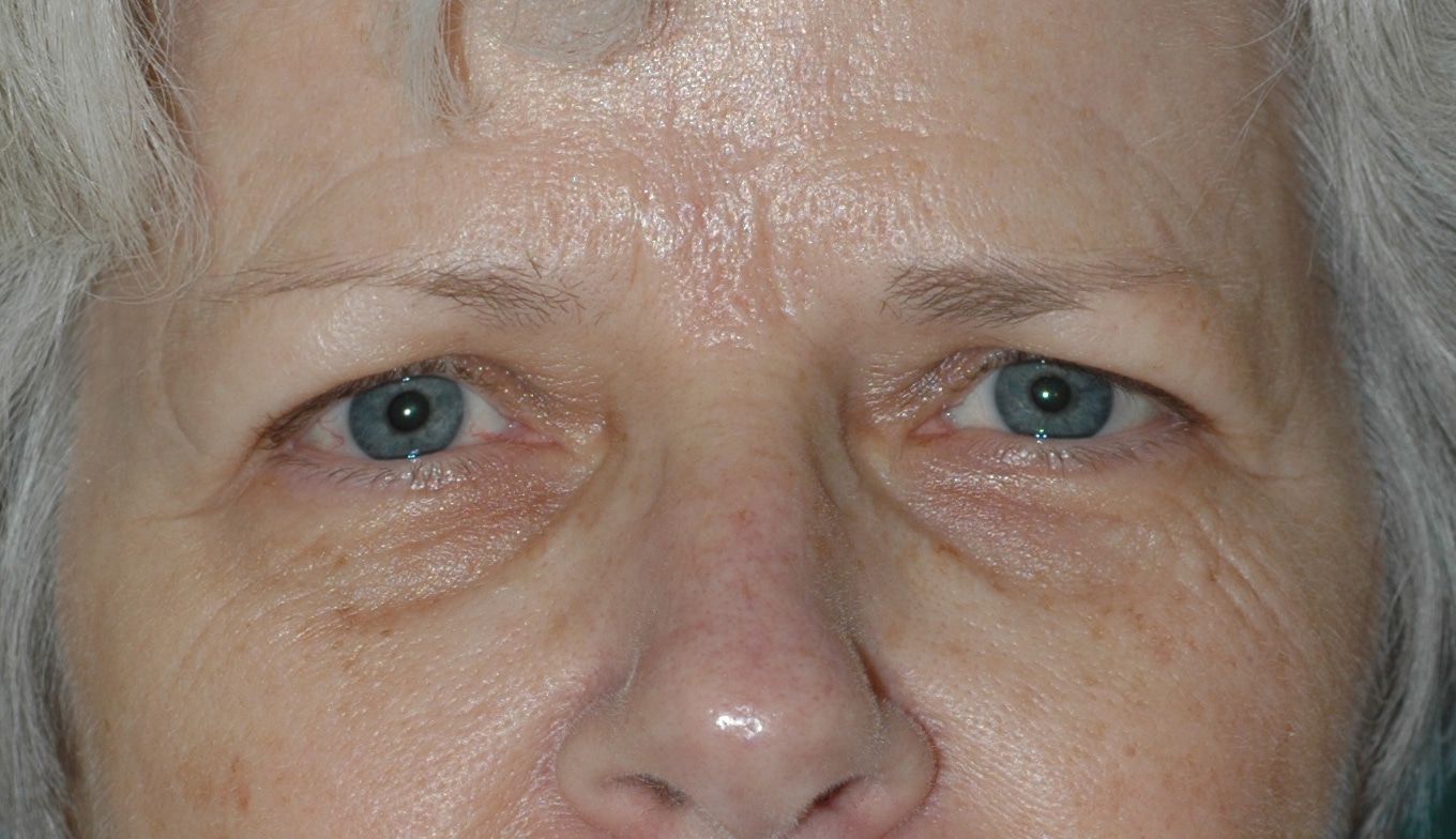 Blepharoplasty in Miami, FL