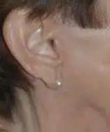 Patient's ear after undergoing facelift surgery by Dr. Bustillo