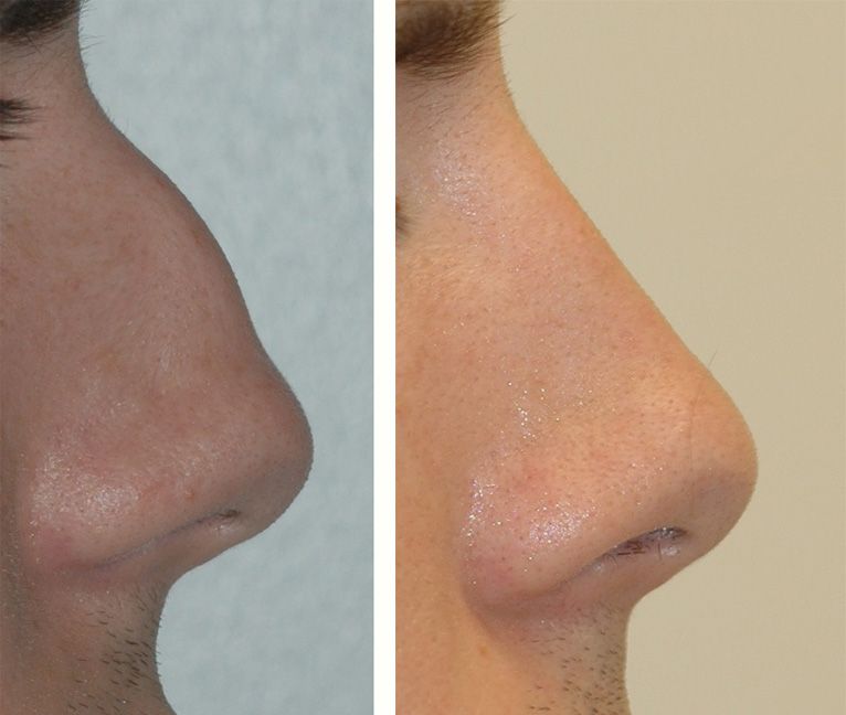 Before and After closed rhinoplasty by Dr. Bustillo