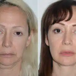 Deep Plane Facelift Before and After Photos in Miami, FL, Patient 19487