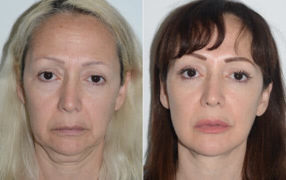 Deep Plane Facelift Before and After Photos in Miami, FL, Patient 19487