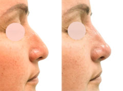 Liquid Rhinoplasty Before and After Photos in Miami, FL, Patient 19149