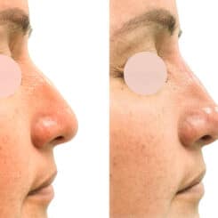 Liquid Rhinoplasty Before and After Photos in Miami, FL, Patient 19149